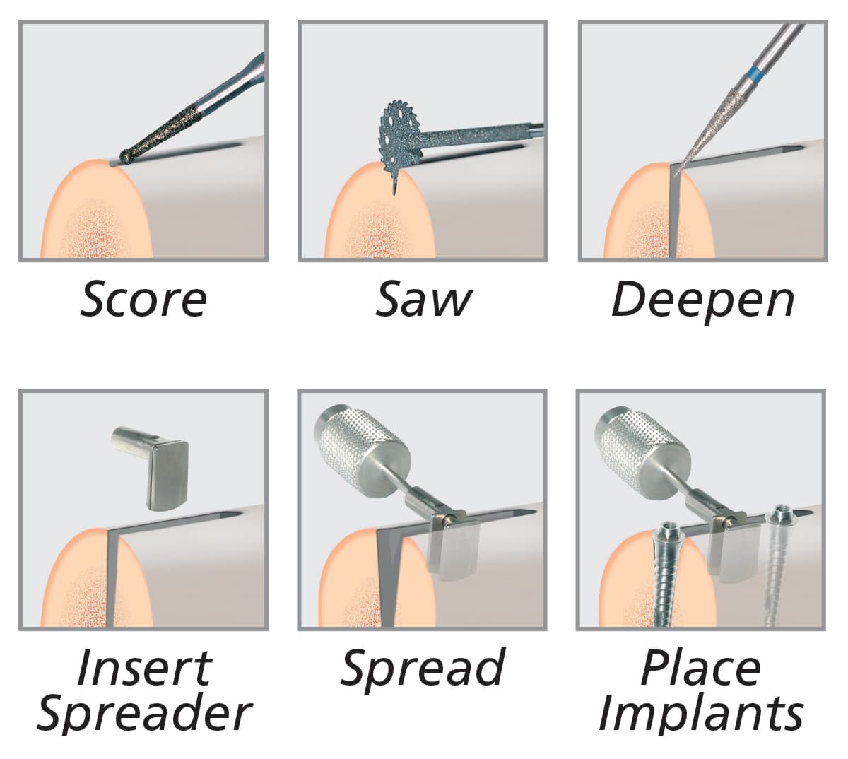 Crest Control Horizontal Bone Spreading System                                                               