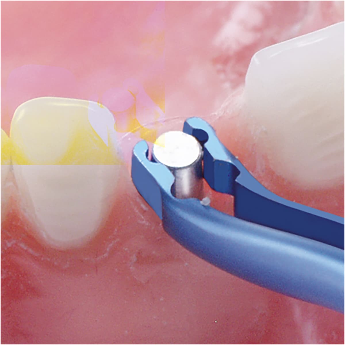 Salvin Titanium Hebel-Melton Abutment Holder