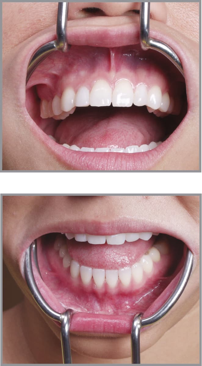 Salvin Implant Retractor