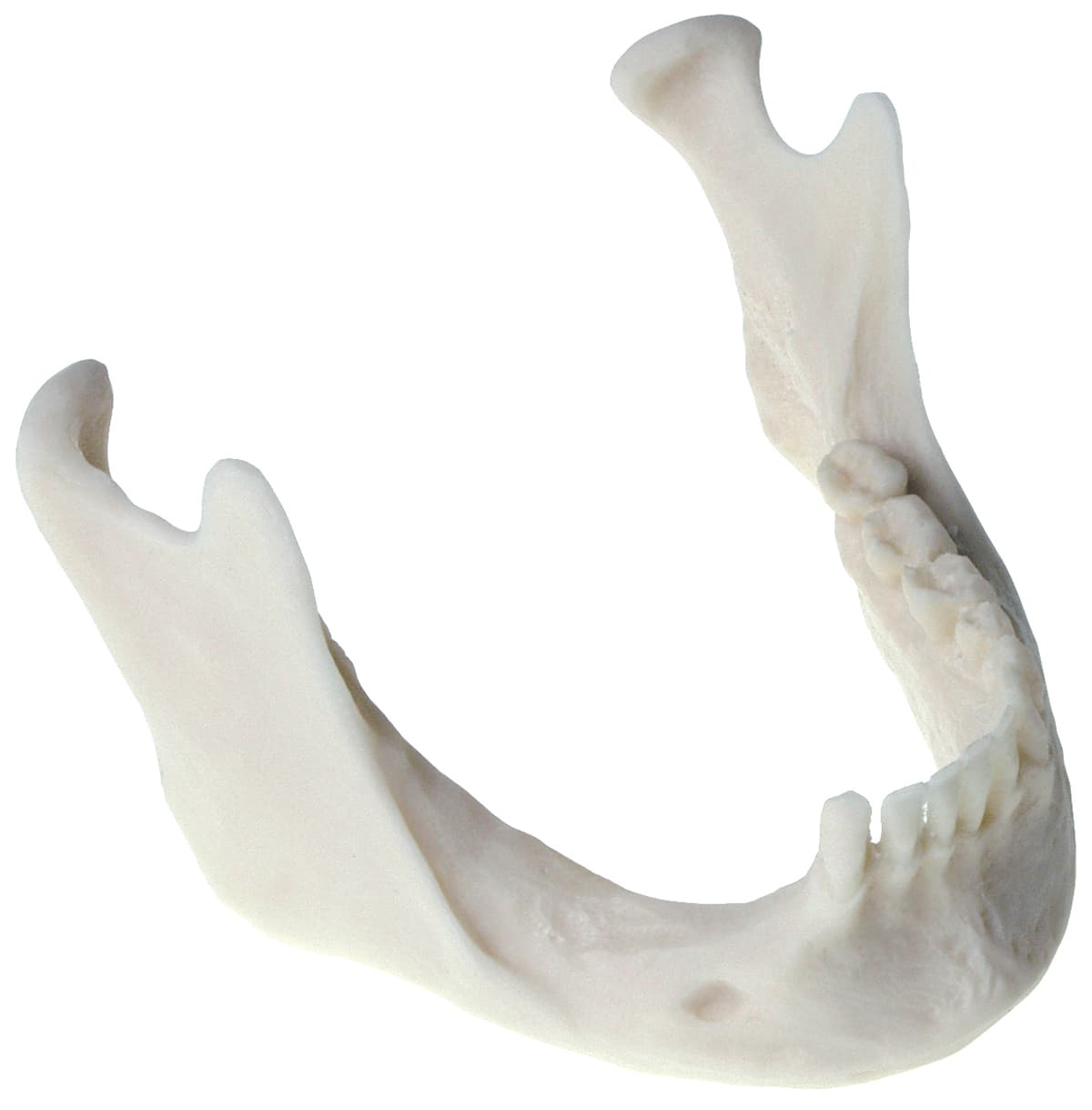 Atrophied Ridge Mandible Bone Loss Model
