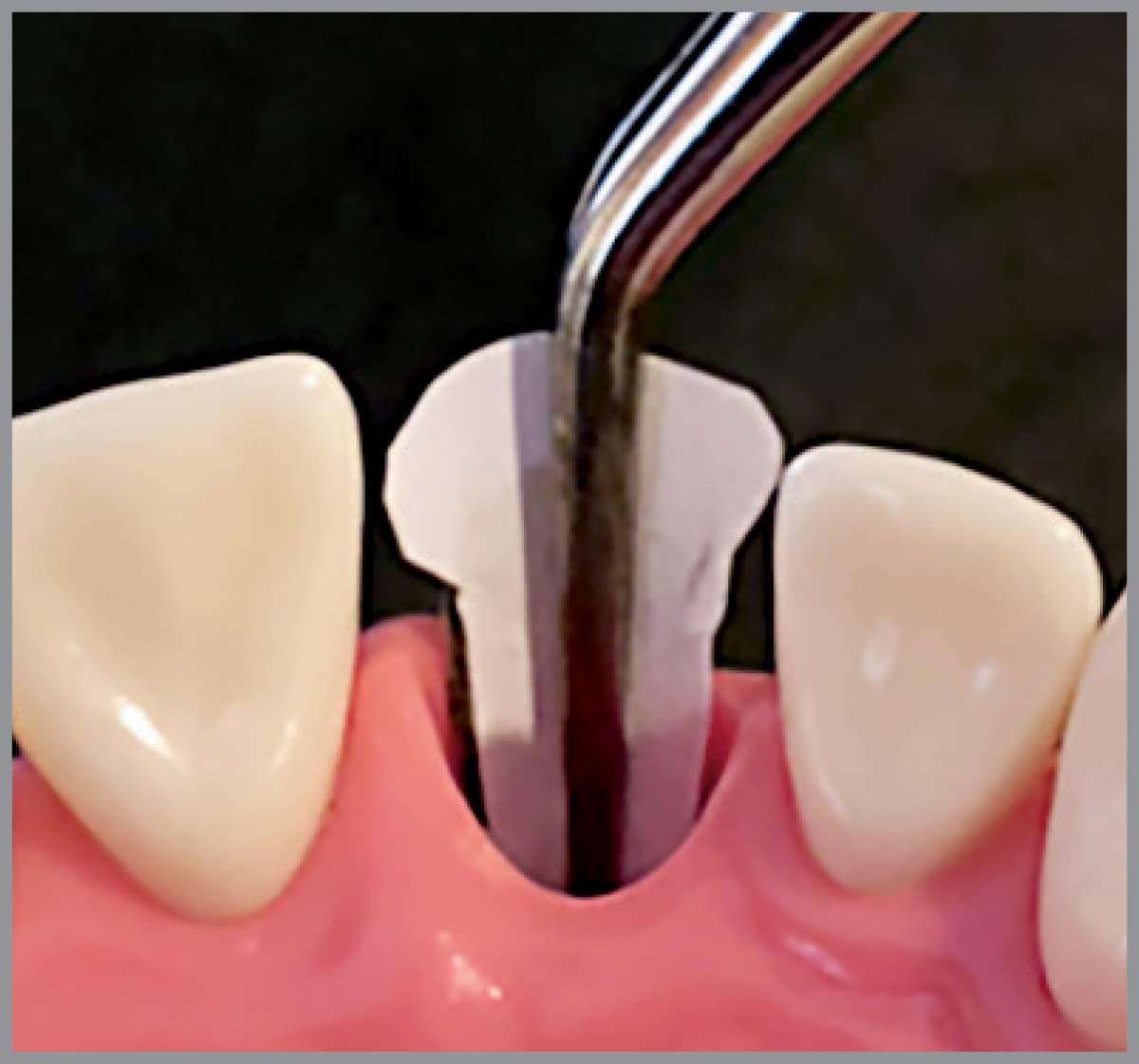 Salvin Membrane Forcep With “Ice Cream Cone” Shaped Tip                                                      