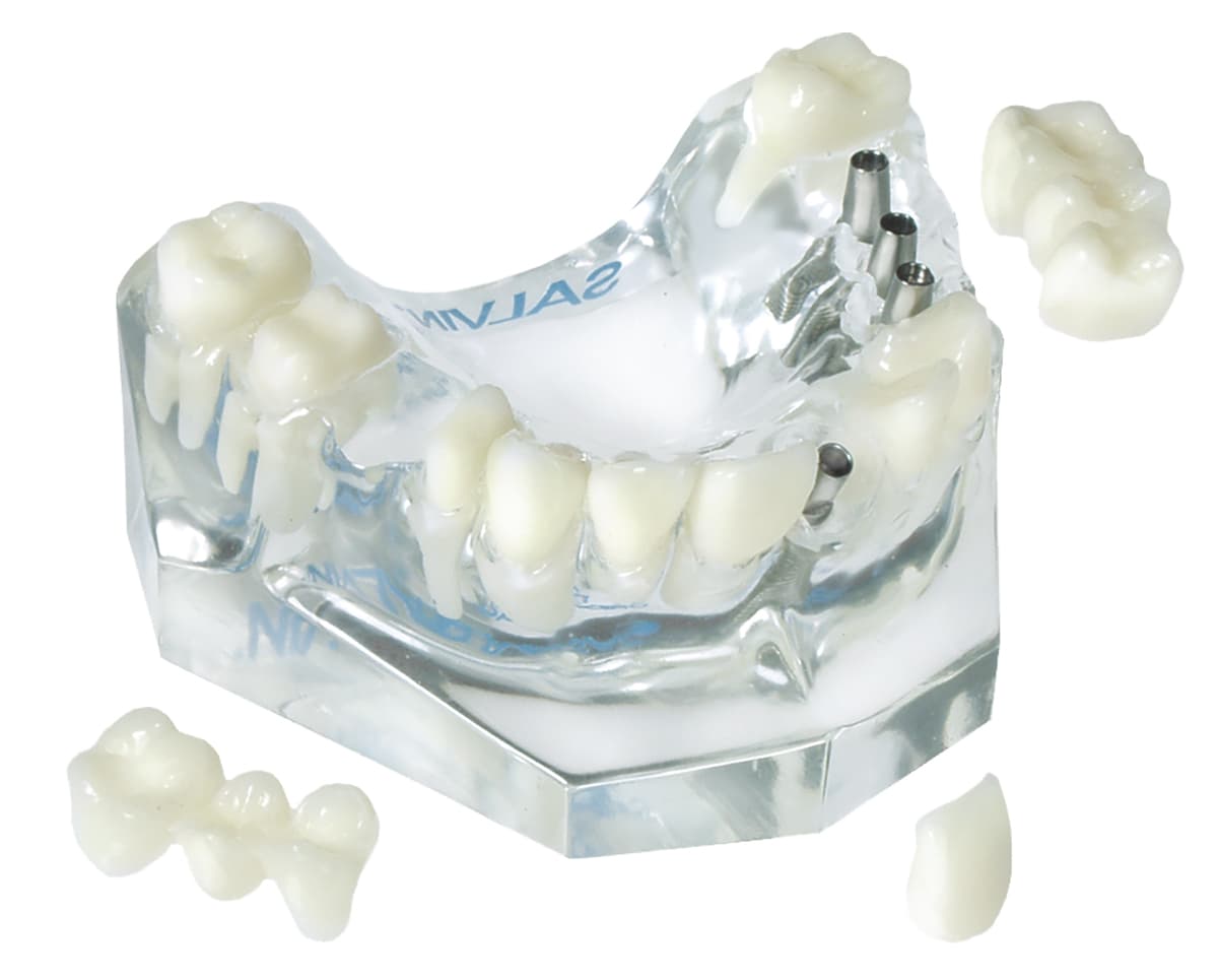 3 Unit Bridge On 3 Implants & Single Crown On 1 Implant & 3 Unit Natural Bridge