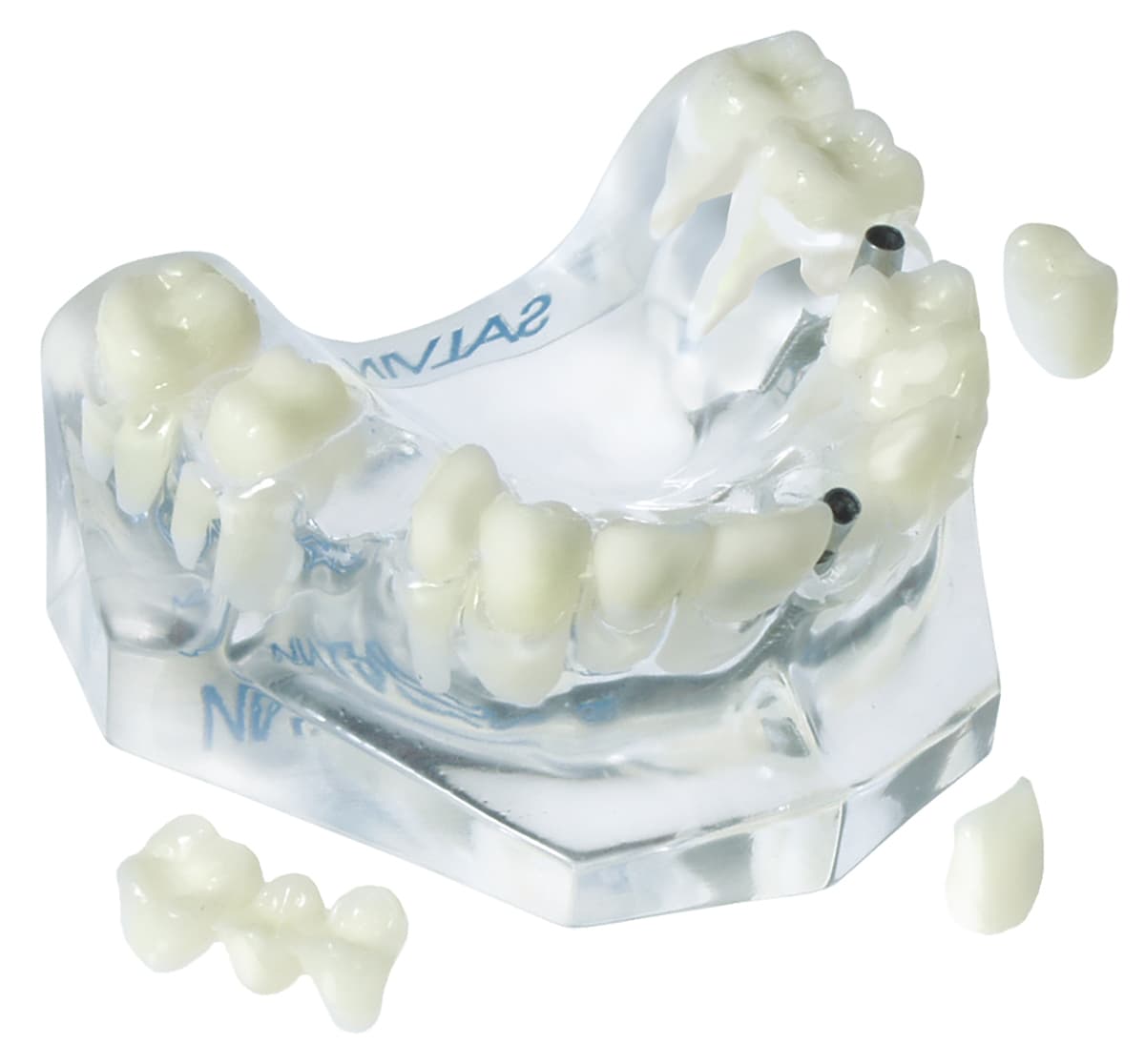 Posterior & Anterior Implant/Natural Bridge Model