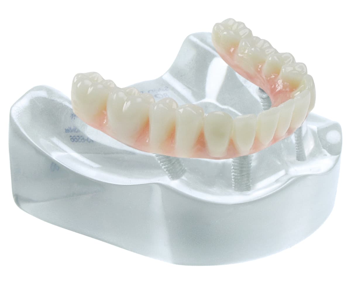 Implant Model - Complete “On 4” Restoration - Upper
