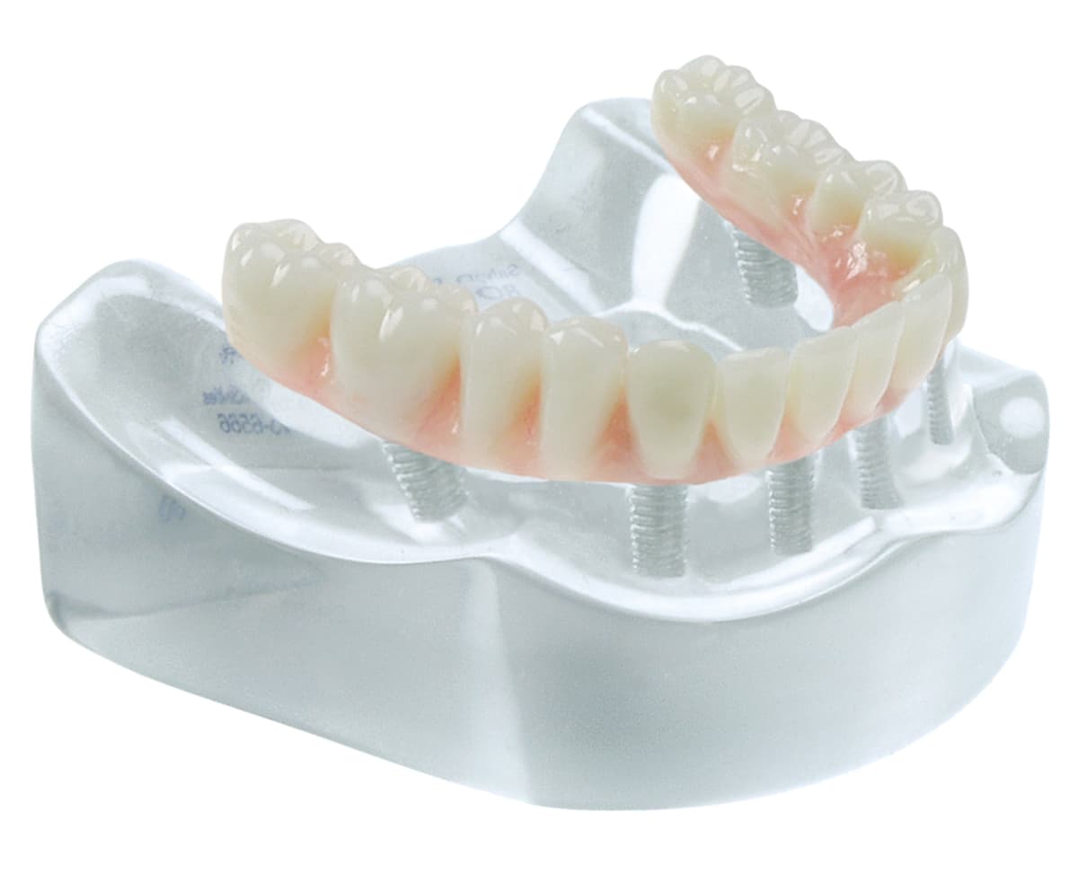 Implant Model - Complete “On 6” Restoration - Upper