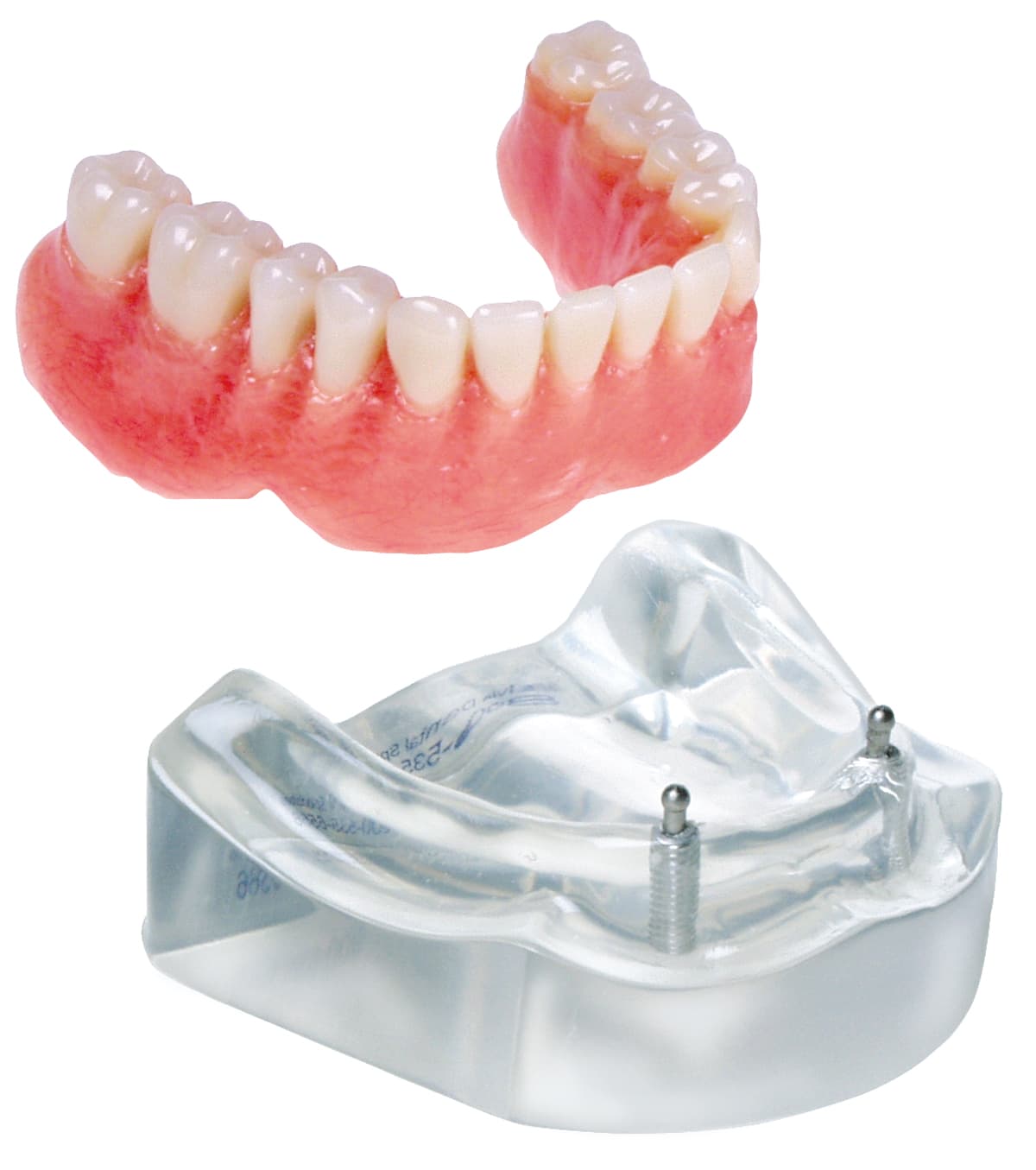 Implant Model - 2 Implant “O” Ring Lower Overdenture