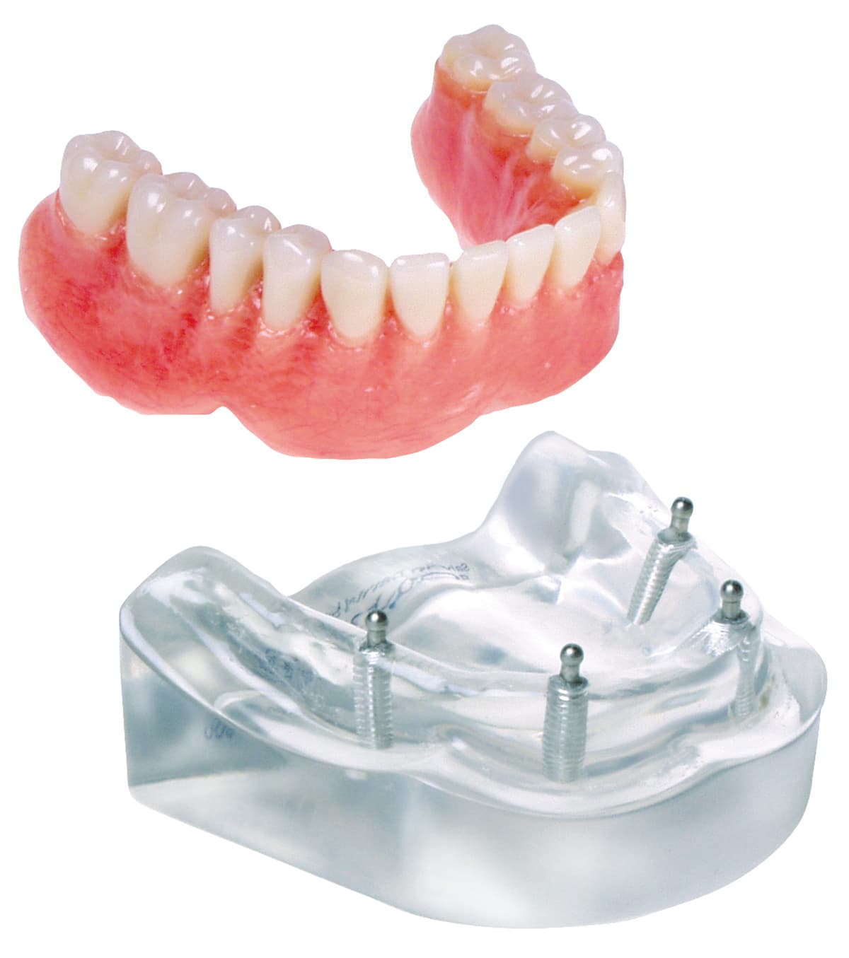 Implant Model - 4 Implant “O” Ring Lower Overdenture