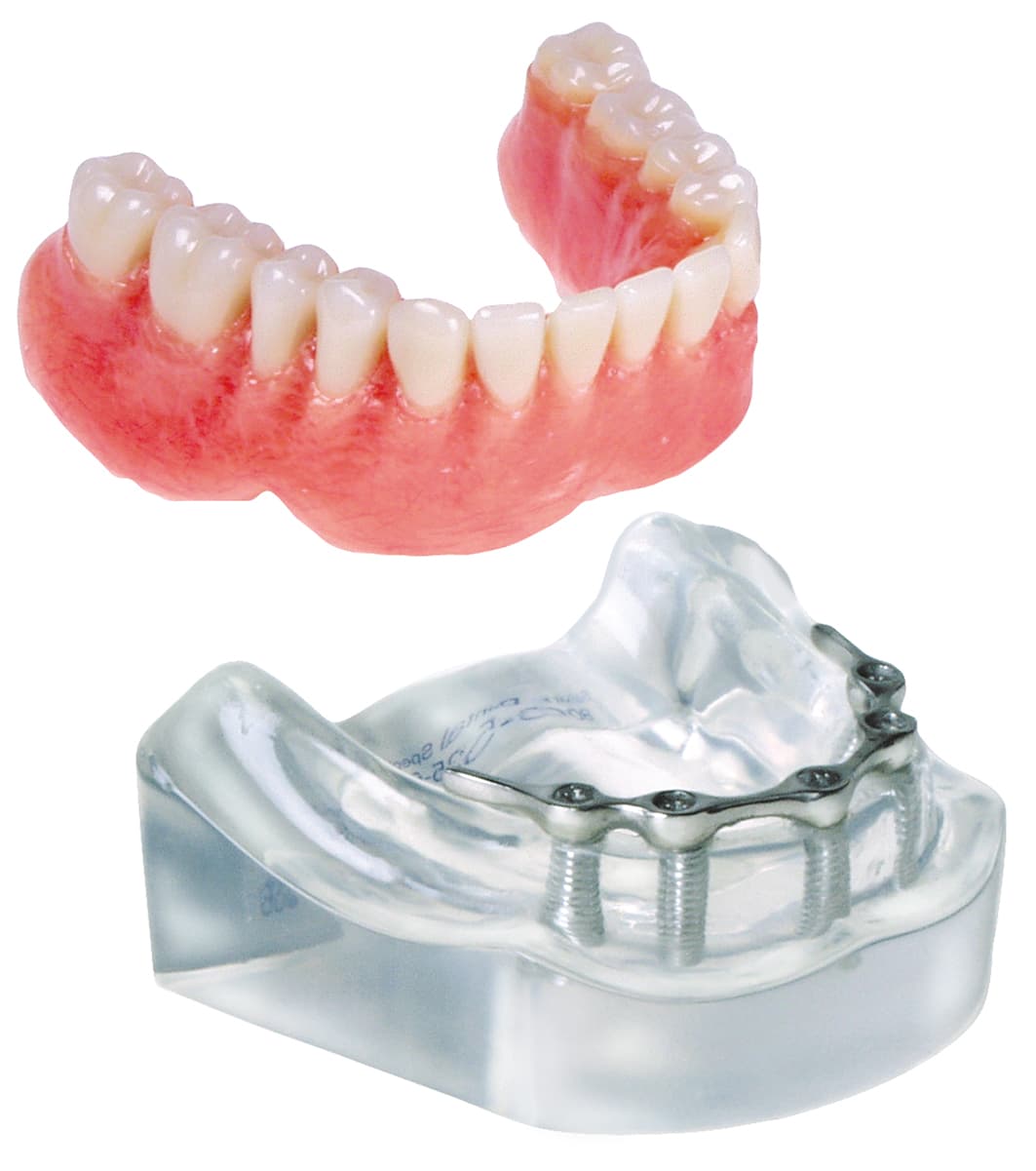 Implant Model - 5 Implant Hader Clip Bar Lower Overdenture