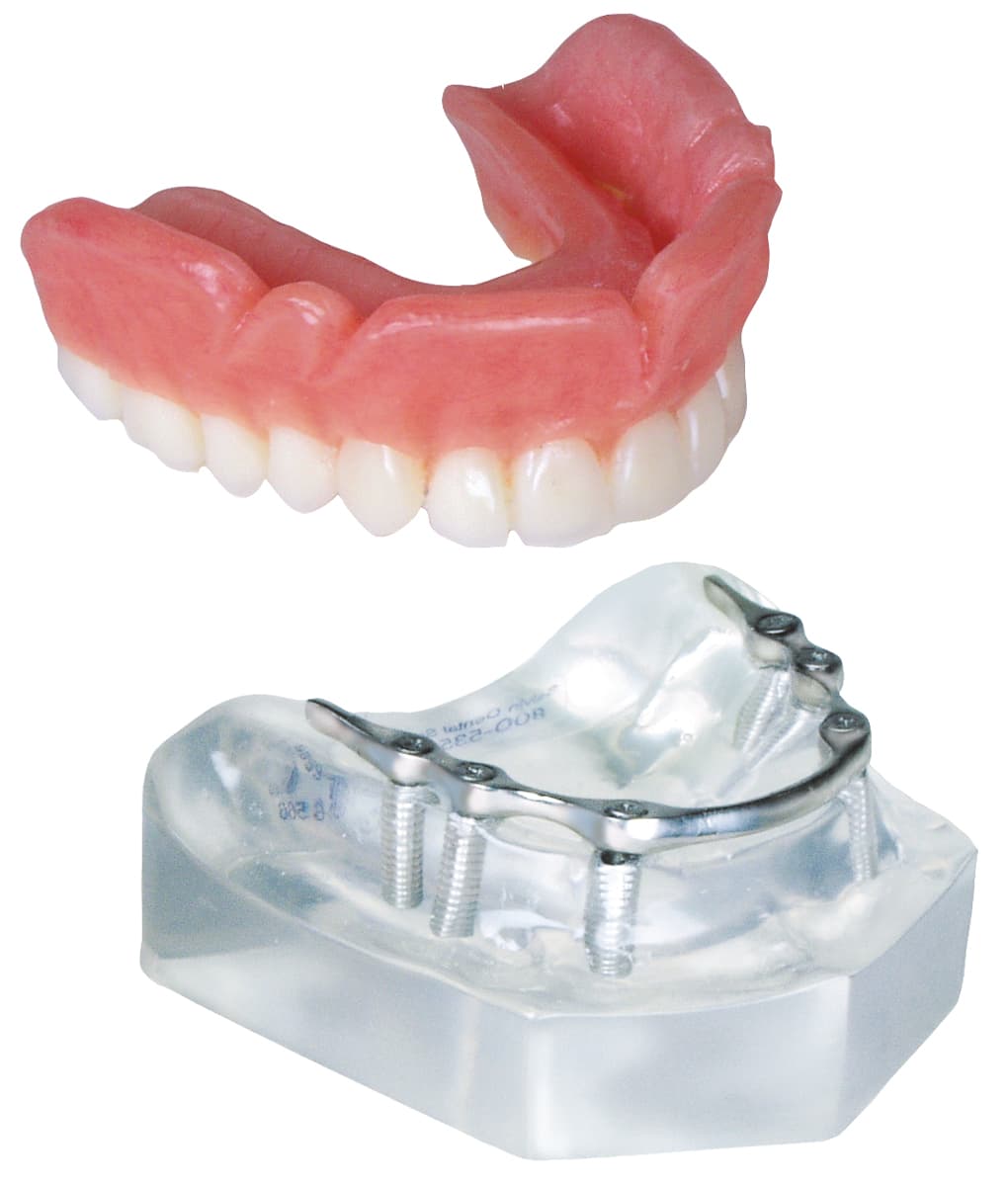 Implant Model - 6 Implant Hader Clip Bar Upper Overdenture