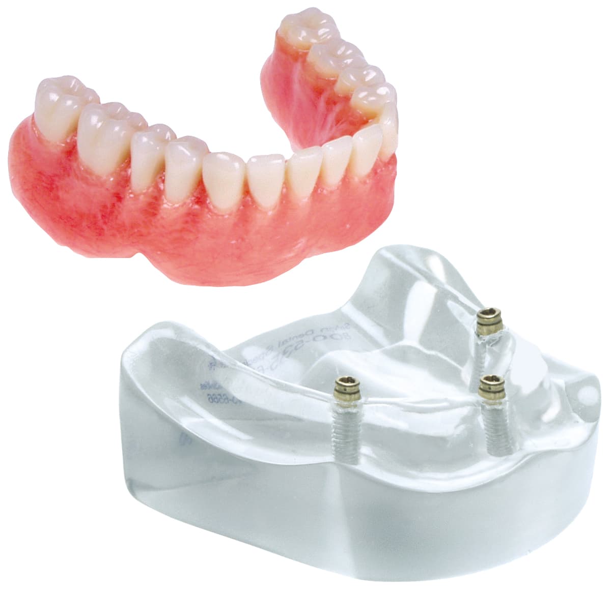 Implant Model - 3 Implant Locator™ Abutment Lower Overdenture