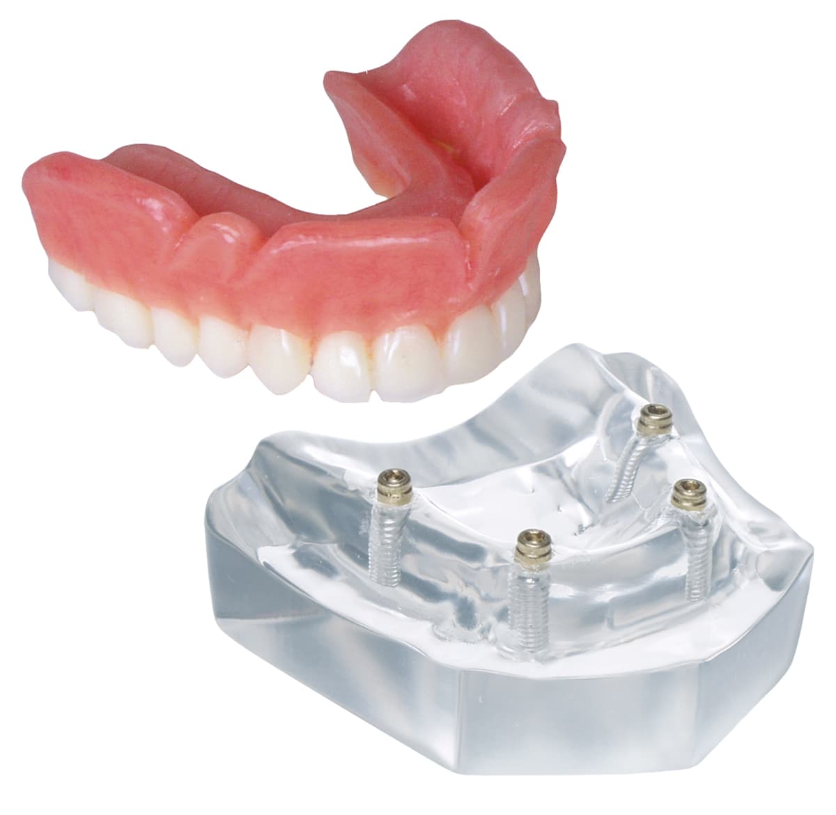 Implant Model - 4 Implant Locator™ Abutment Upper Overdenture