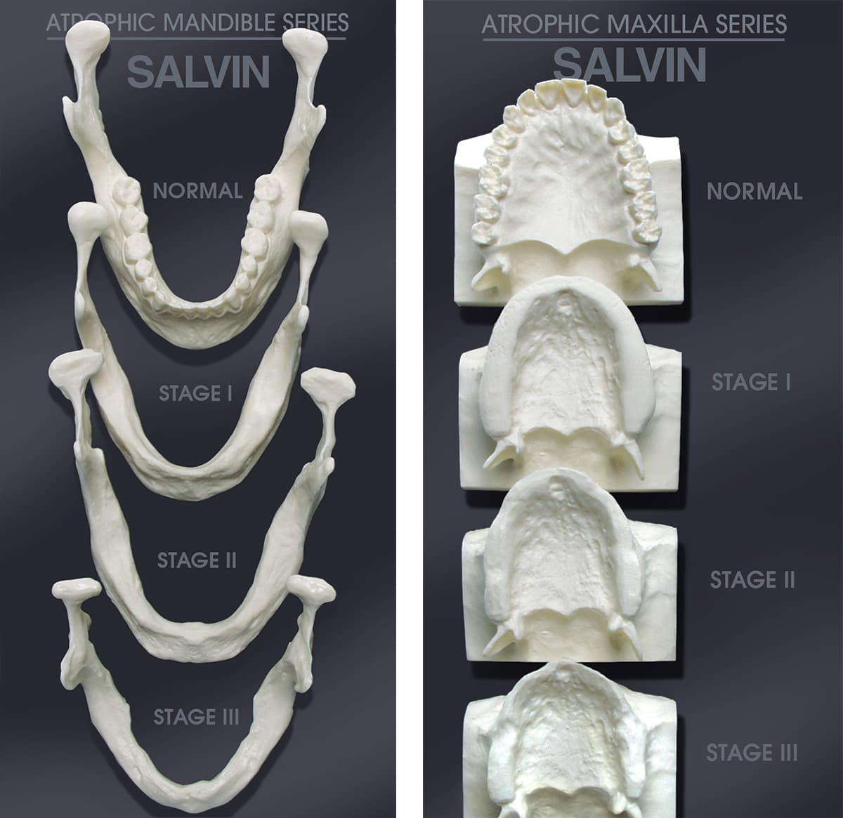 Set Of Both Mandible & Maxilla Bone Loss Models