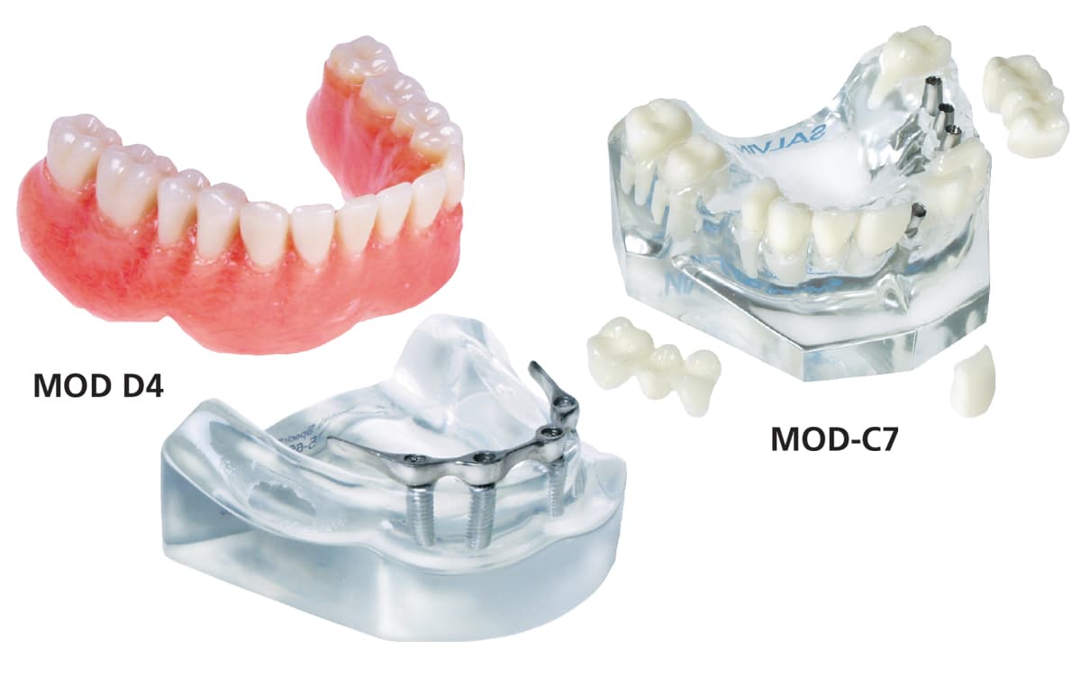 Bar Overdenture Model + Crown & Bridge Model