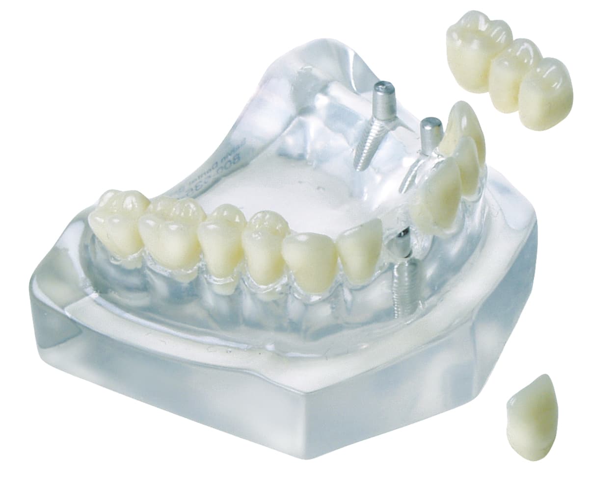 Implant Model - 3 Unit Bridge On 2 Implants Single Crown On 1 Implant