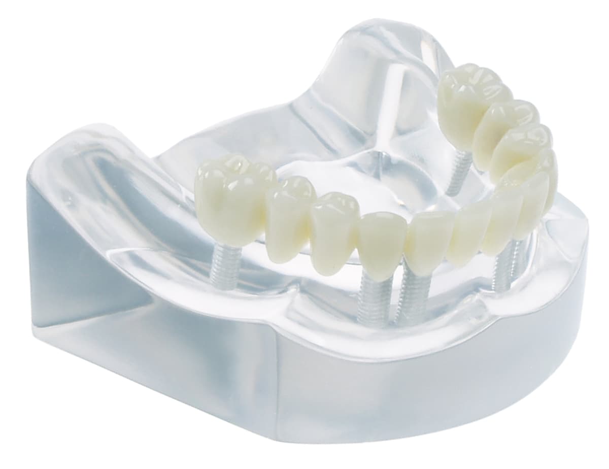 Implant Bridge Model - 6 Implant Full Arch Cemented