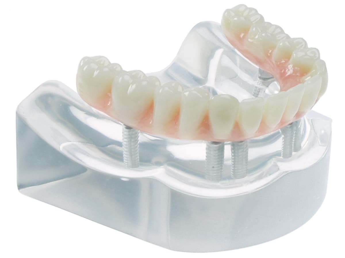 Implant Model - 6 Implant High Water Bridge