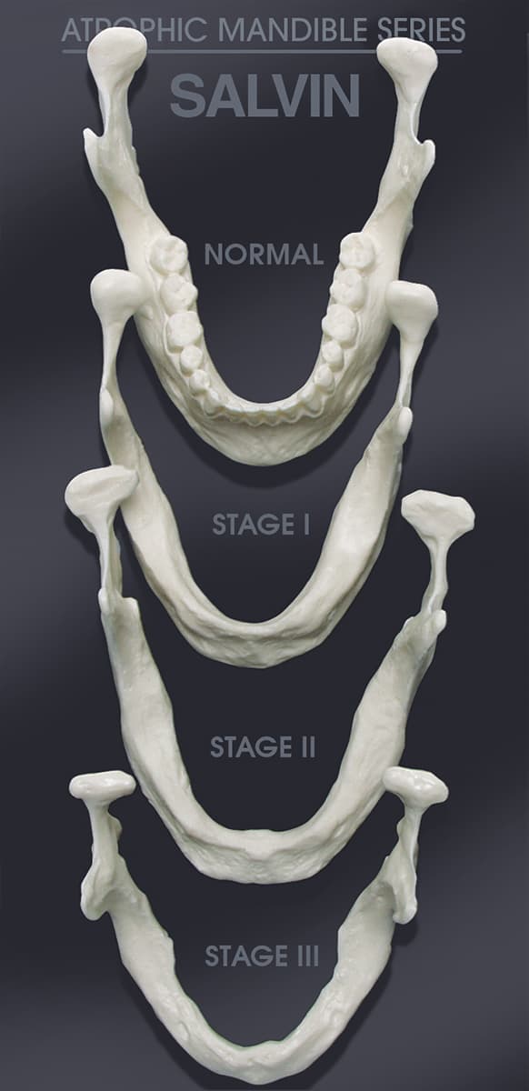 Mandible Bone Loss Model Set