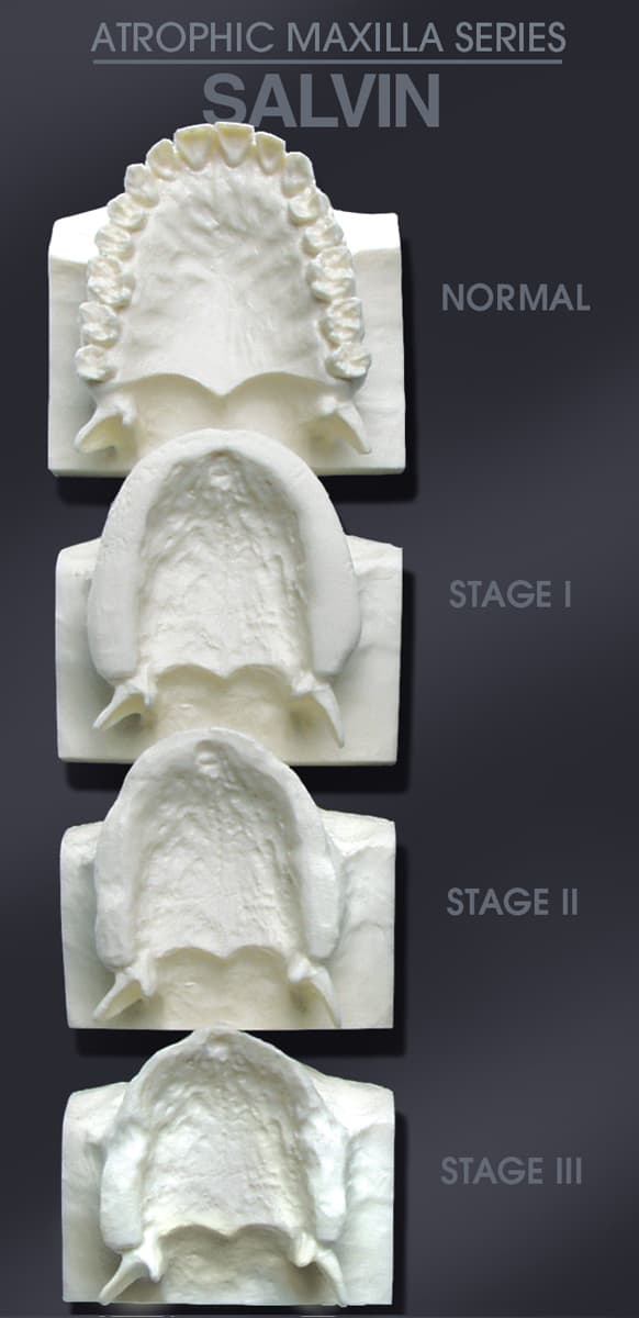Maxilla Bone Loss Model Set