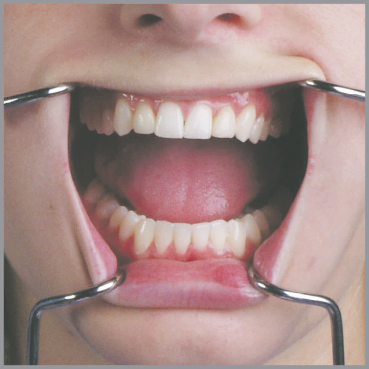 Salvin Orringer Retractor