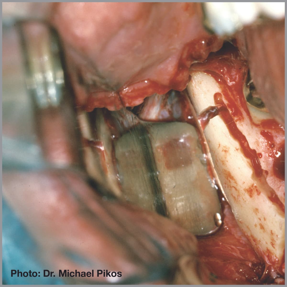 Salvin Pikos Ramus Retractor