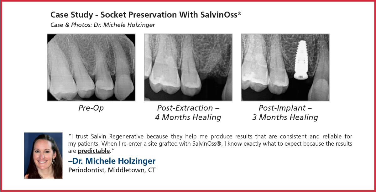 SalvinOss® Xenograft Bone Graft Material - 1 c (0.5g) - 250-1000 microns