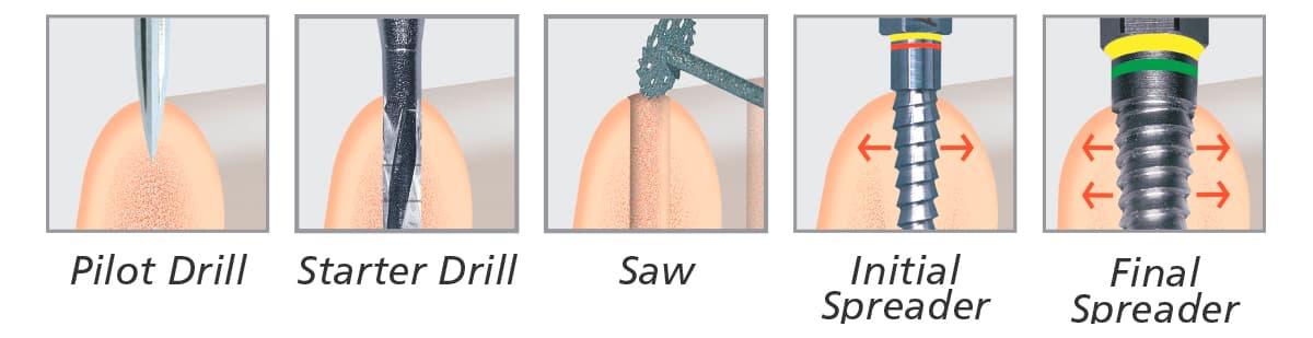 Basic Bone Spreading System                                                                                  