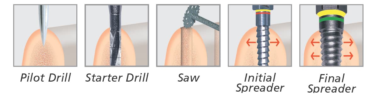 Comprehensive Bone Spreading Kit                                                                             