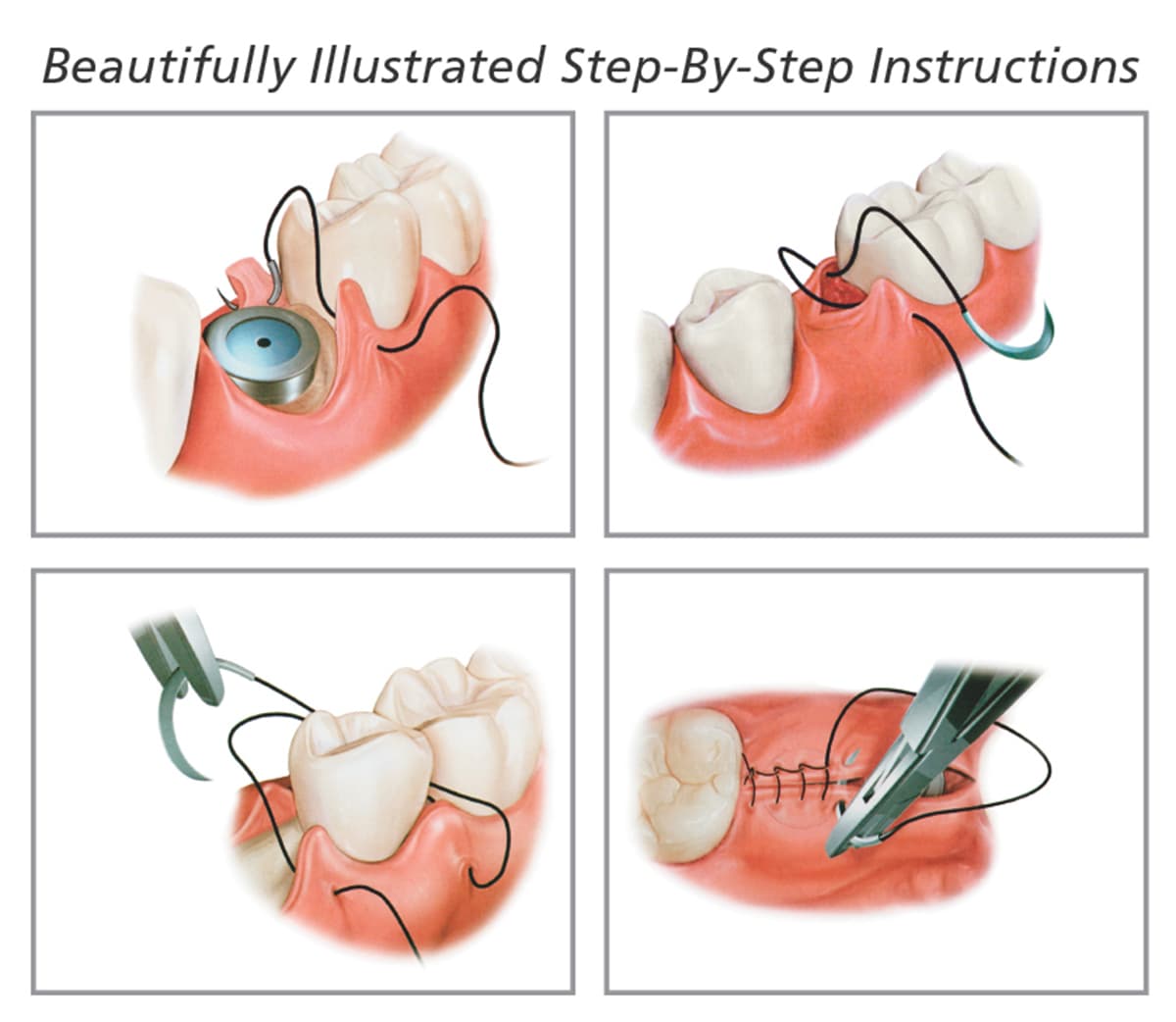 Principles of Dental Suturing                                                                                