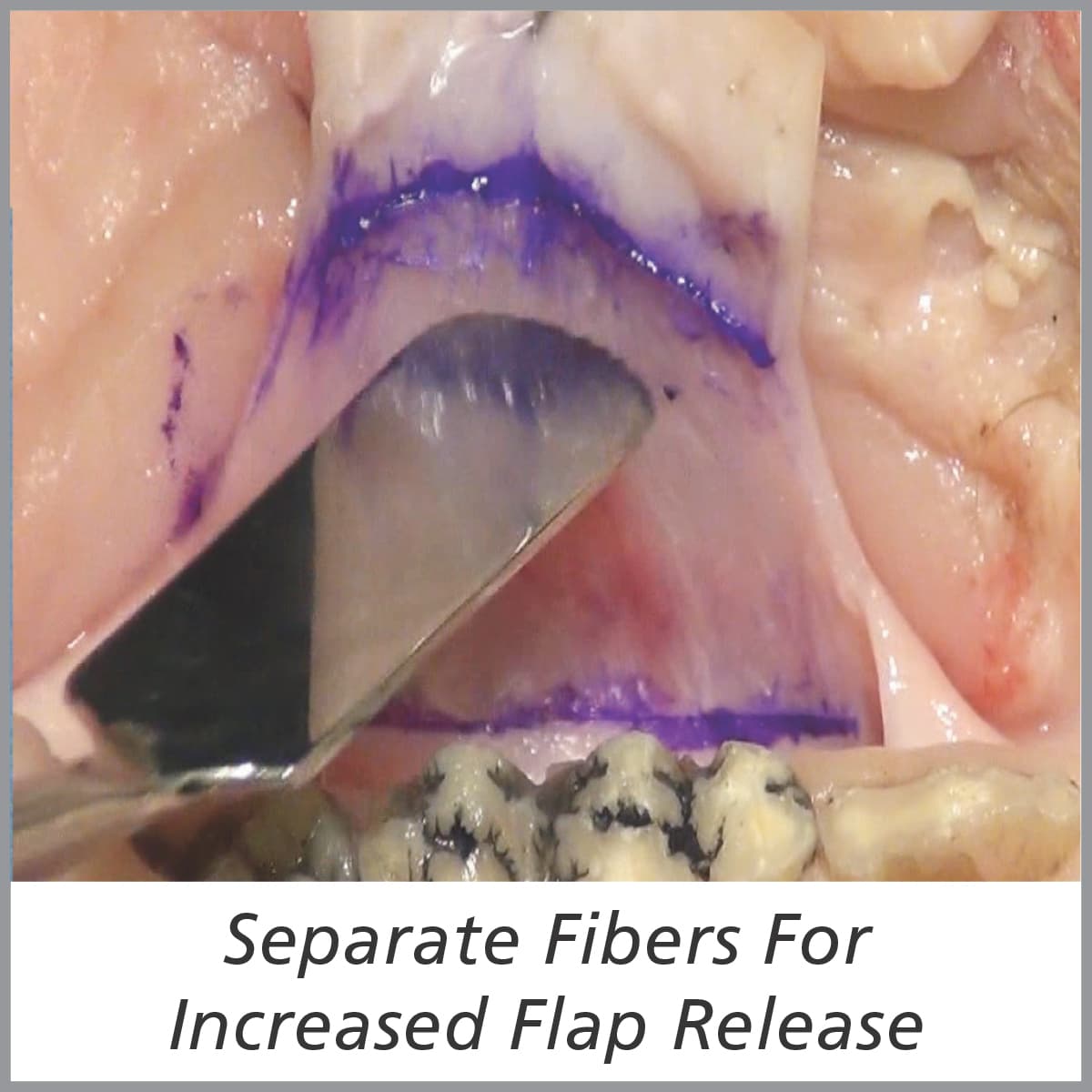 Tissue Rake #1 For Increased Flap Extension