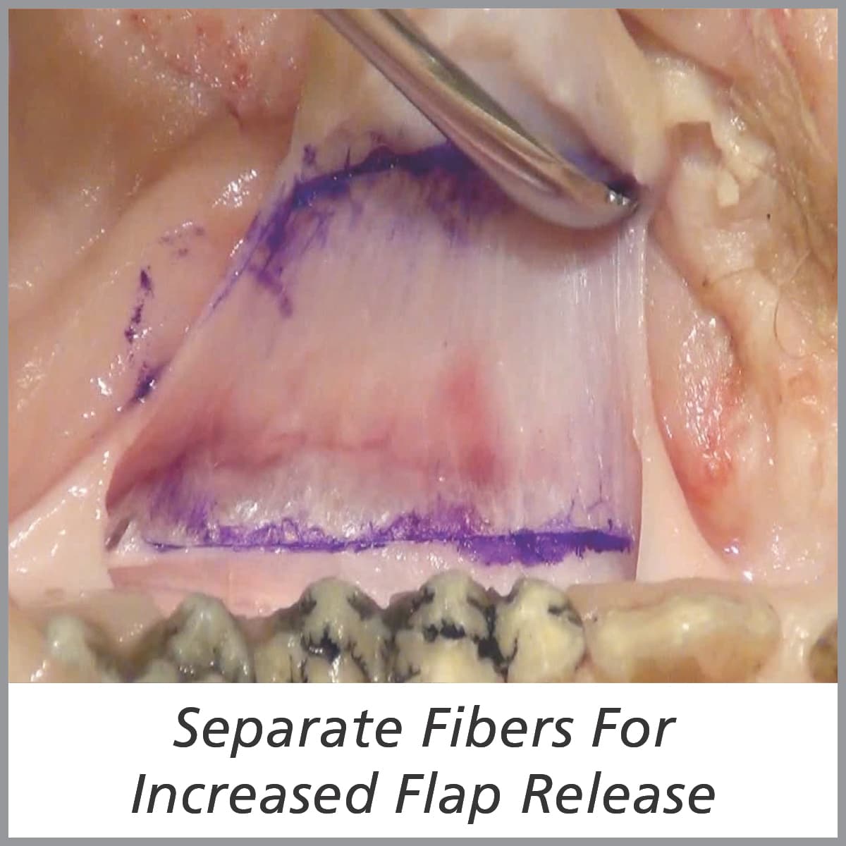 Tissue Rake #2 For Increased Flap Extension