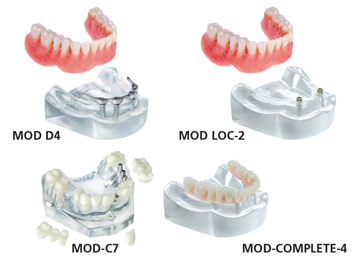 Bar Overdenture + Locator™ + Crown & Bridge + \"On 4\" Models