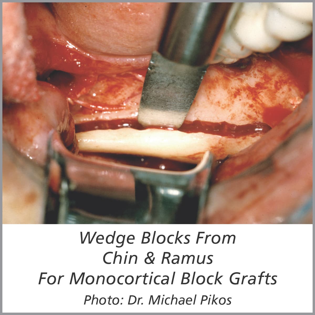 Set Of 4 Tatum \"D\" Spreaders With Cassette