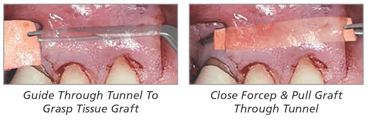 Salvin Tunnel Forcep Straight