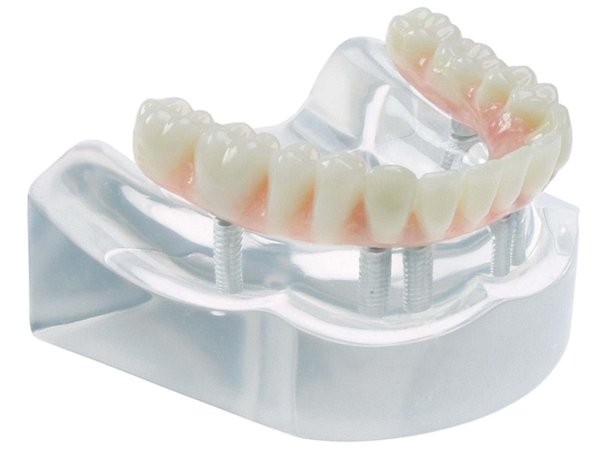 Implant Model – 6 Implant High Water Bridge – Salvin Dental Specialties